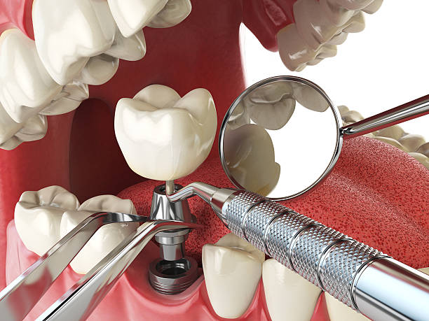 Best Emergency Denture Repair in Suffern, NY